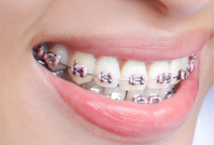 braces