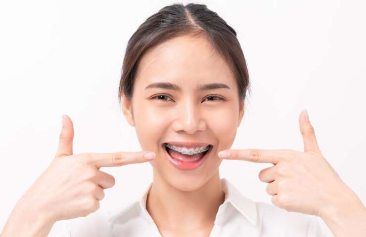 All You Need to Know About Braces and Clear Aligners