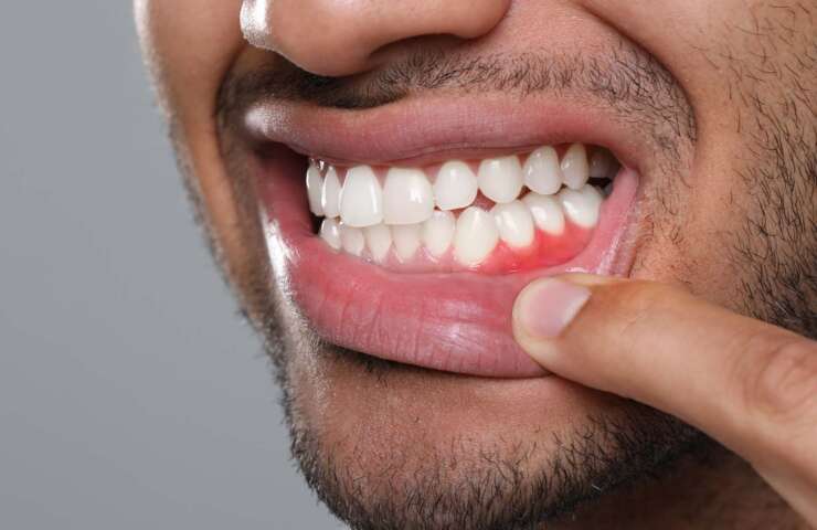 Best Treatments for Periodontal Disease | Midtown Dental Guide