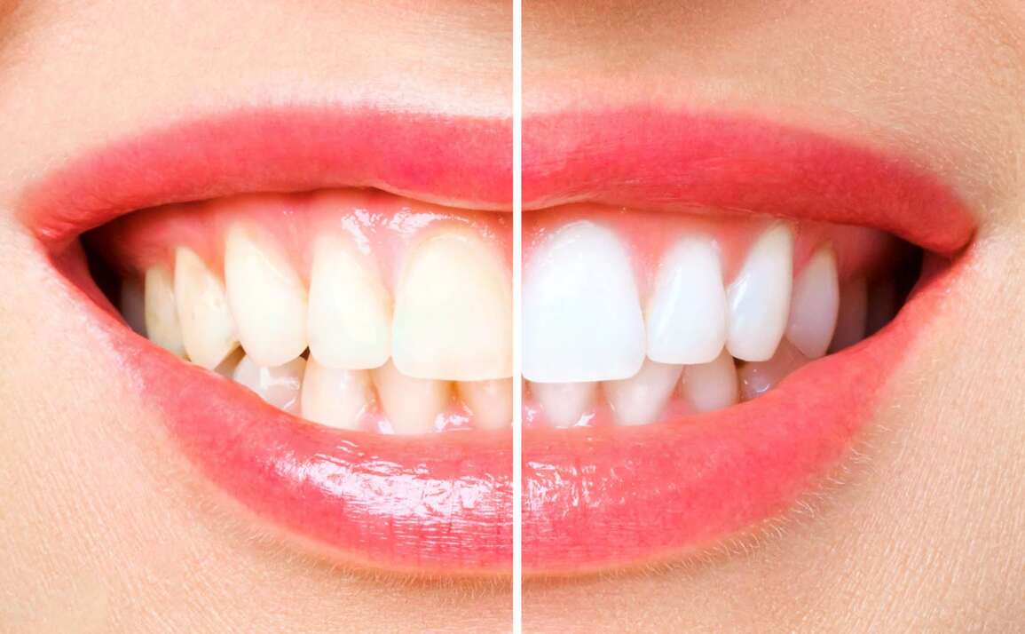 Is Teeth Whitening Safe and Effective