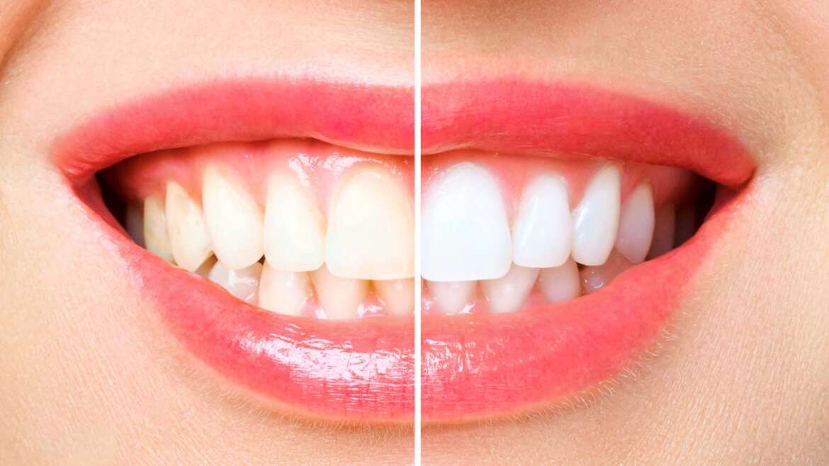 Is Teeth Whitening Safe and Effective