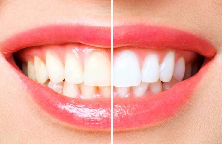 Is Teeth Whitening Safe and Effective