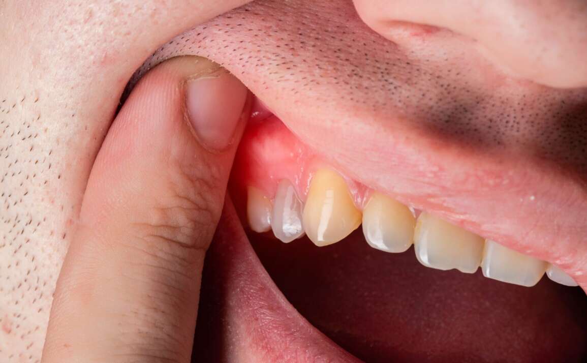 What Is Gingivitis and How to Know if I Have It