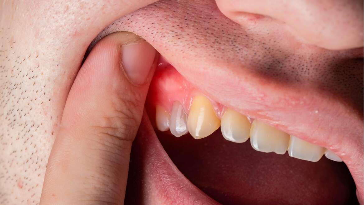What Is Gingivitis and How to Know if I Have It