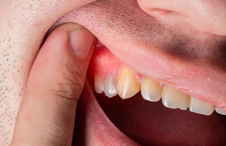 What Is Gingivitis and How to Know if I Have It