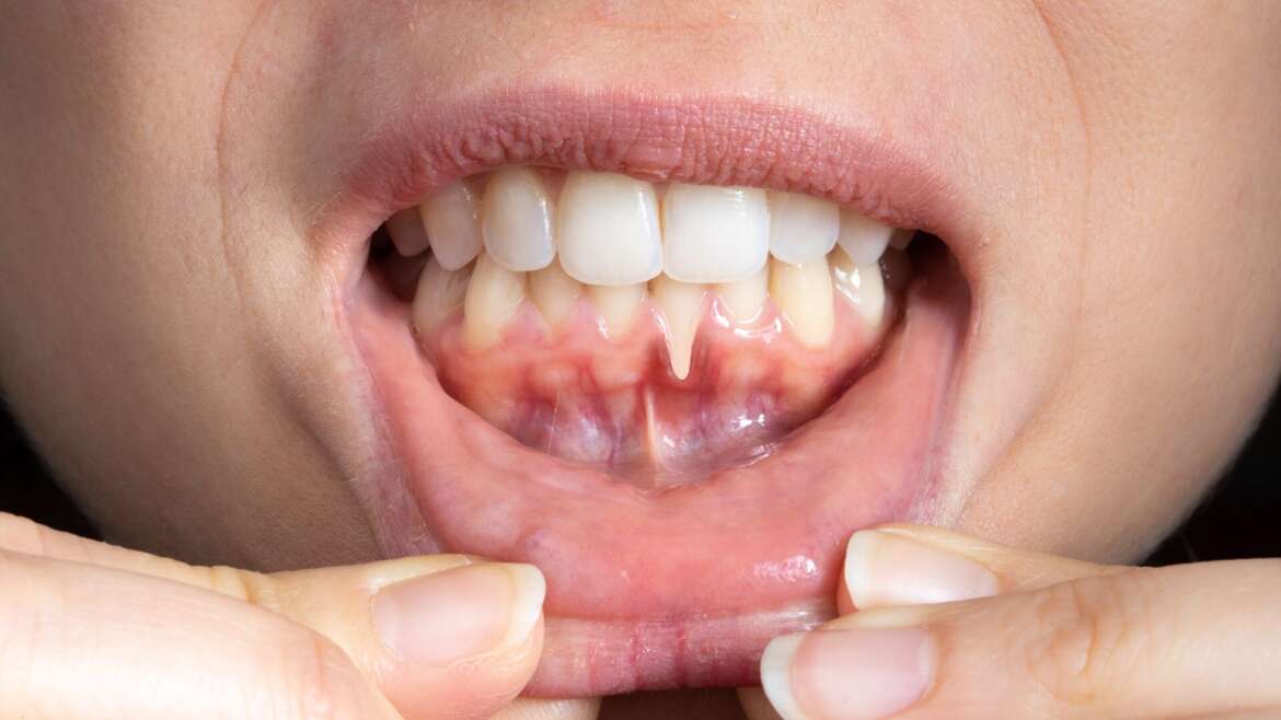 Why Gum Disease Could Be Harming Your Whole Body