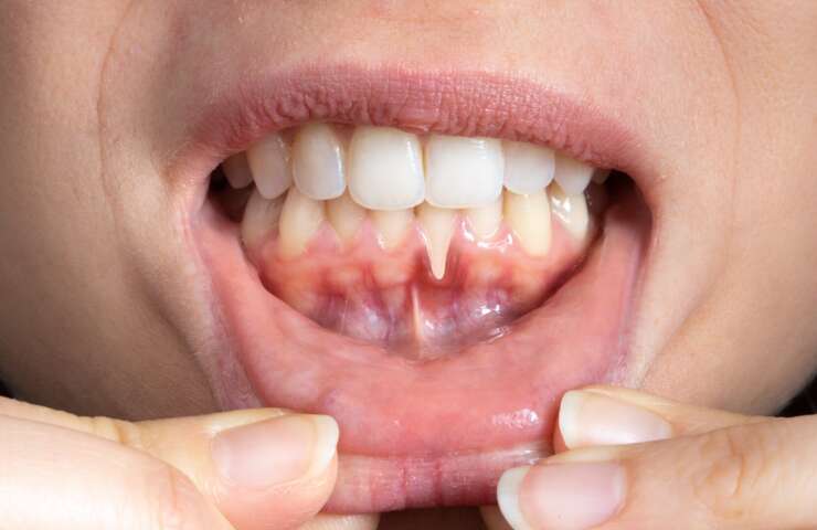 Why Gum Disease Could Be Harming Your Whole Body