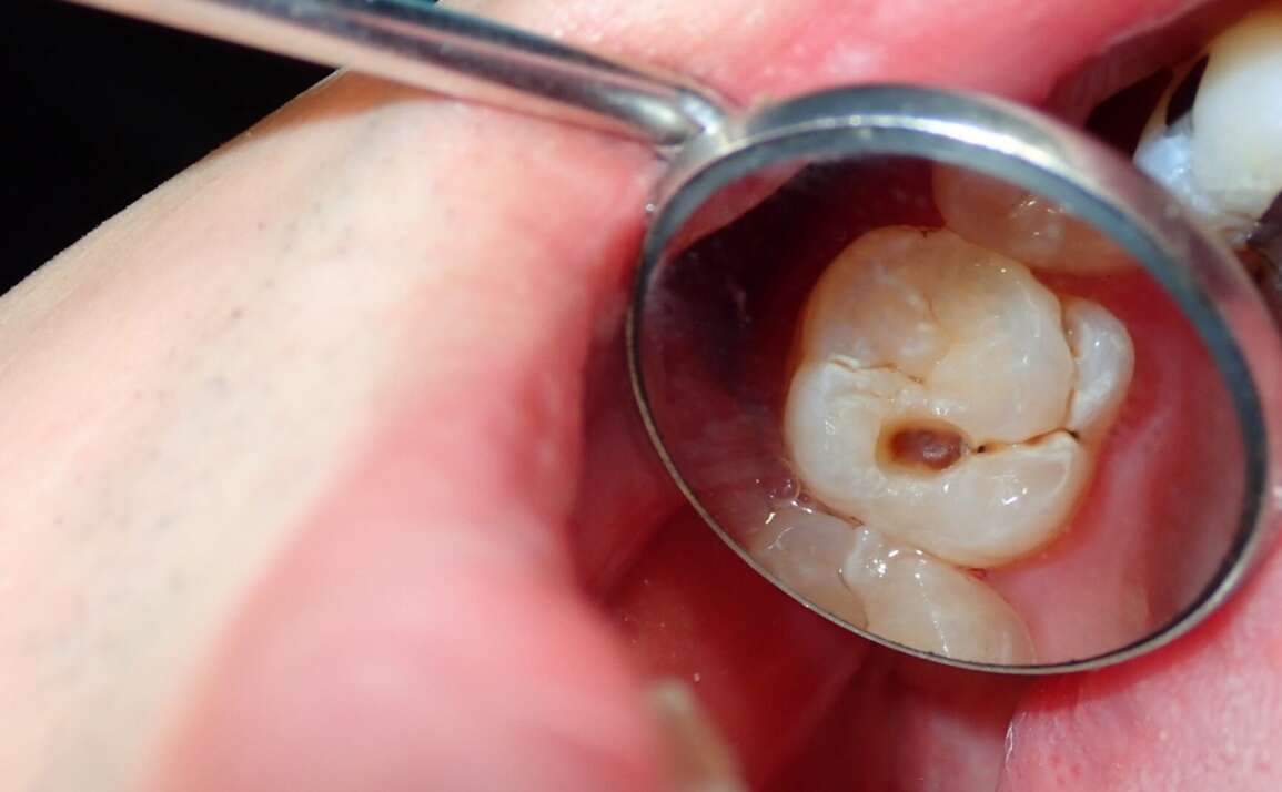 9 Symptoms You Might Need a Dental Filling | Midtown Dental Toronto