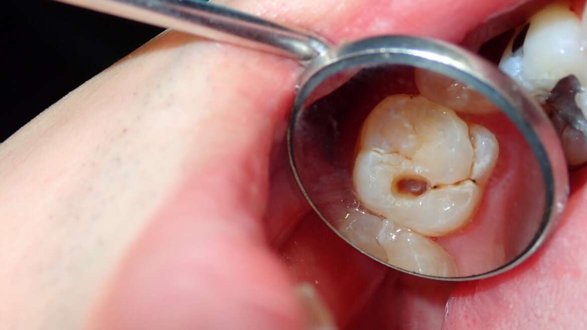 9 Symptoms You Might Need a Dental Filling | Midtown Dental Toronto