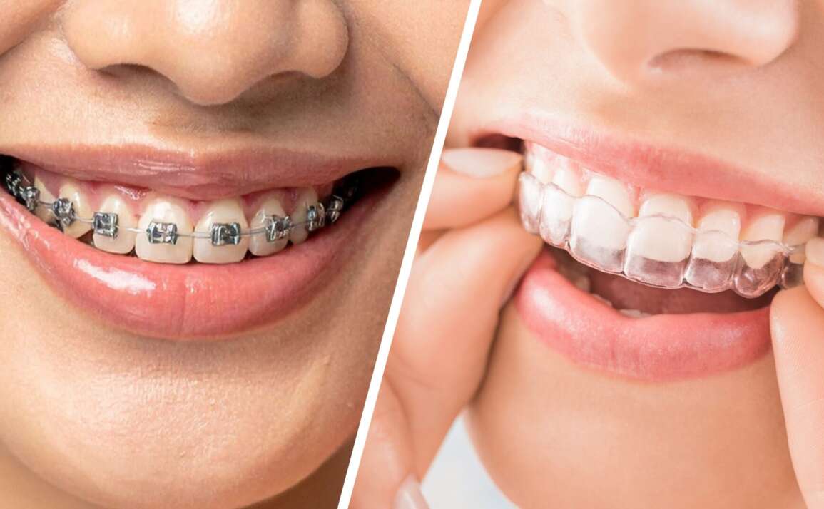 Braces vs. Aligners: Options for Straighter Teeth – Midtown Dental Centre (Midtown / Toronto)