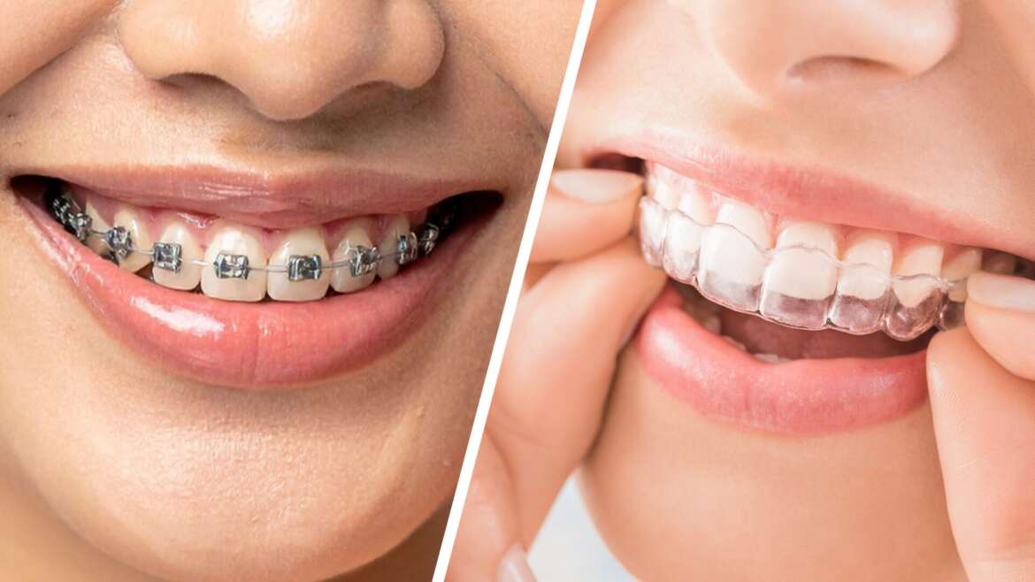 Braces vs. Aligners: Options for Straighter Teeth – Midtown Dental Centre (Midtown / Toronto)