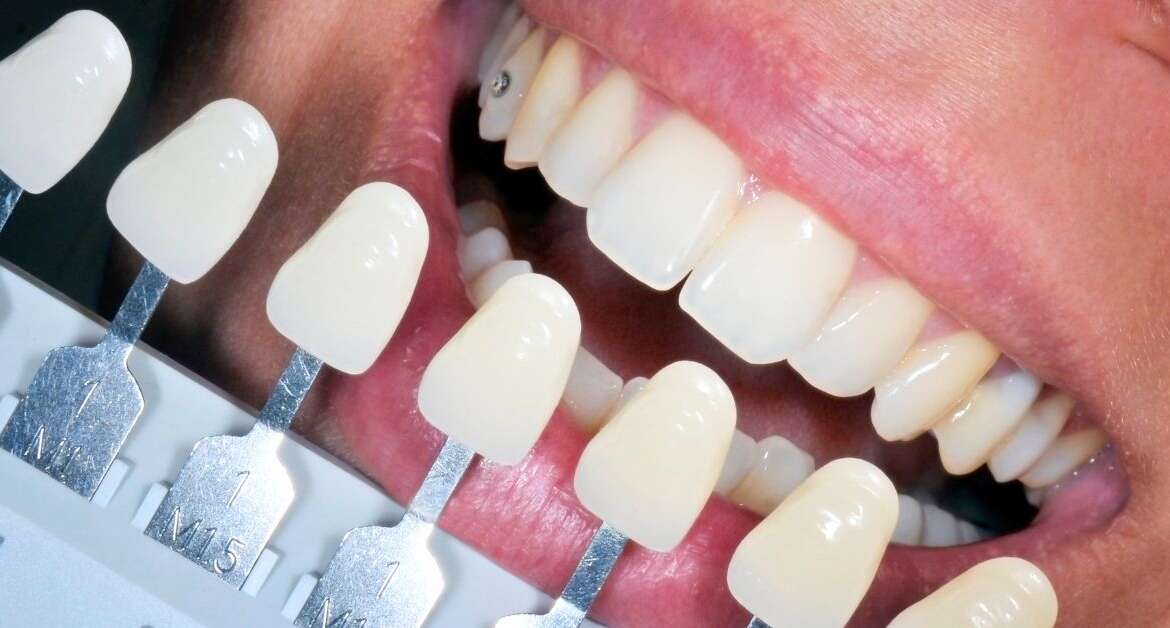 Rebuilding and Restoring Smiles with Restorative Dentistry – Midtown Dental Toronto (Midtown / Toronto)