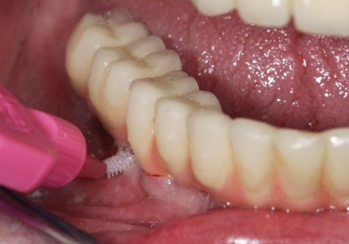 Implant Maintenance Programme