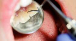 Inside a Dental Cleaning: What Really Happens – Midtown Dental Centre (Midtown / Toronto)